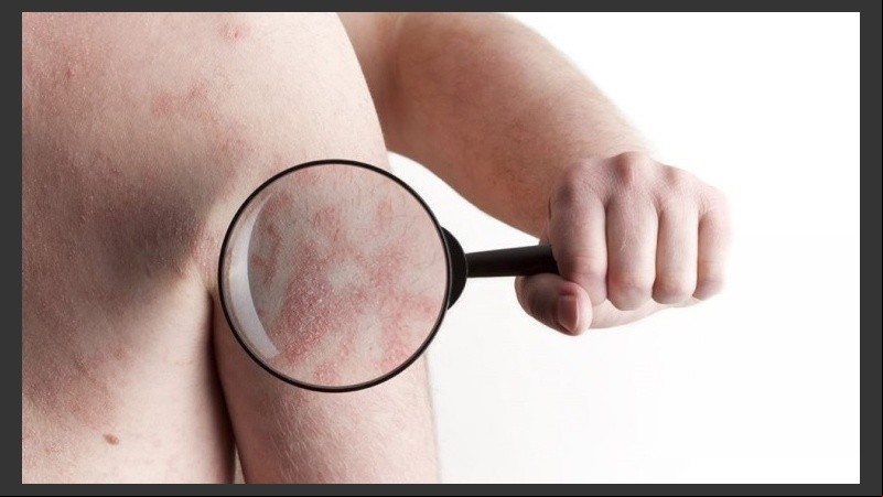 Una psoriasis mal controlada afecta enormemente la calidad de vida.