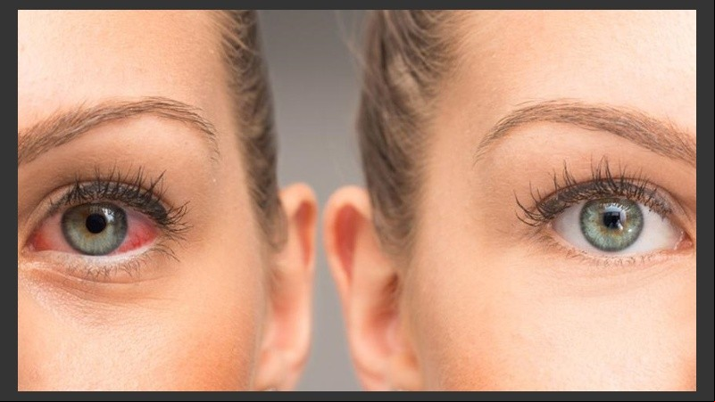 El diagnóstico de glaucoma se hace en una consulta preventiva o en una consulta de control.