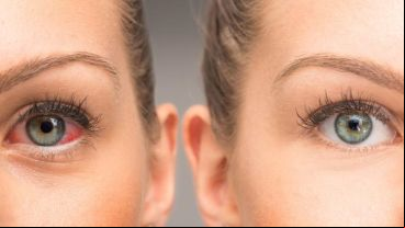 El diagnóstico de glaucoma se hace en una consulta preventiva o en una consulta de control.