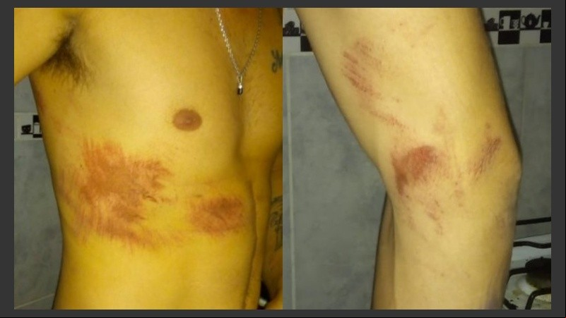 Los jóvenes mostraron las heridas en sus cuerpos.