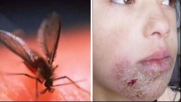 La forma más común de trasmisión es a través de la picadura de un insecto infectado.