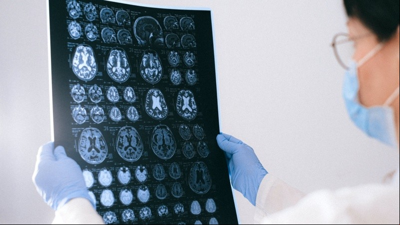 Es la forma más común de demencia y posiblemente representa del 60% al 70% de los casos de demencia neurodegenerativa.
