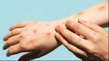 En caso de haber tenido o cercano con una persona que tiene viruela símica o lo sospecha, o si se tienen síntomas compatibles, es importante realizar una consulta médica temprana.