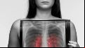 Realizan en Rosario una campaña de detección temprana de cáncer de pulmón